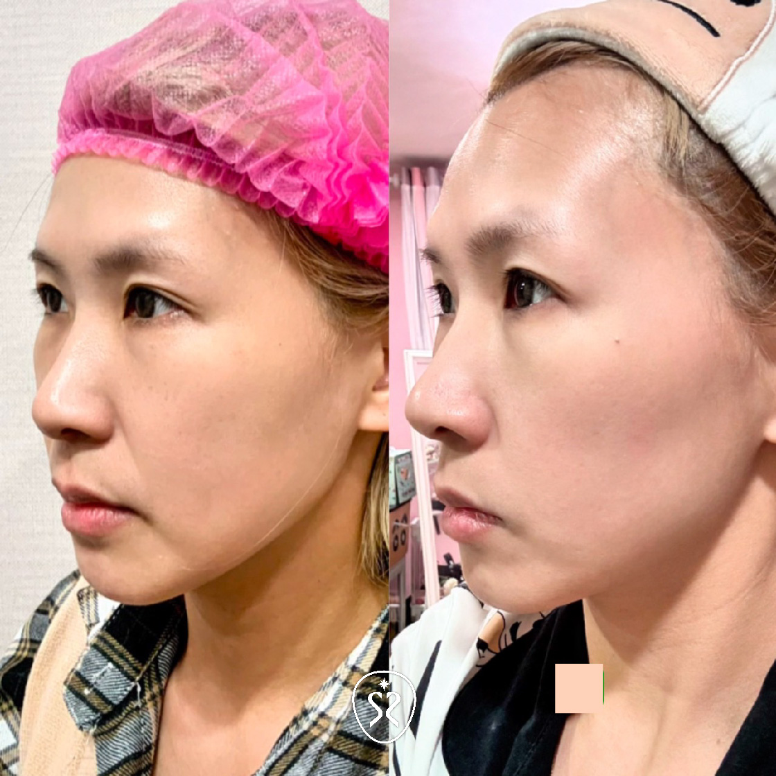 玩美電波為非侵入式電波治療系統，採容積式加熱，將能量從表皮層深入到皮下組織，促進膠原蛋白增生，以達到緊緻肌膚的效果